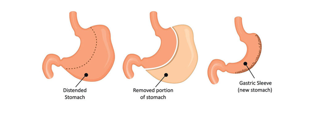 Gastric sleeve surgery being performed at a modern hospital in Istanbul