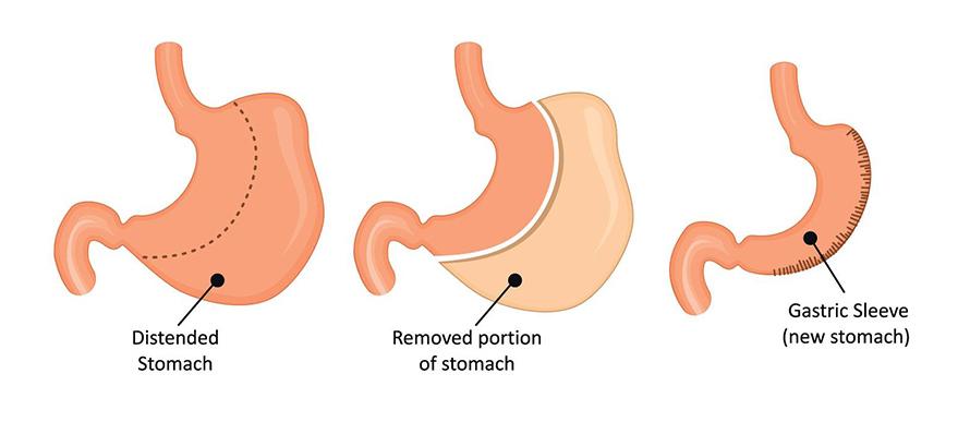 Gastric sleeve surgery being performed at a modern hospital in Istanbul
