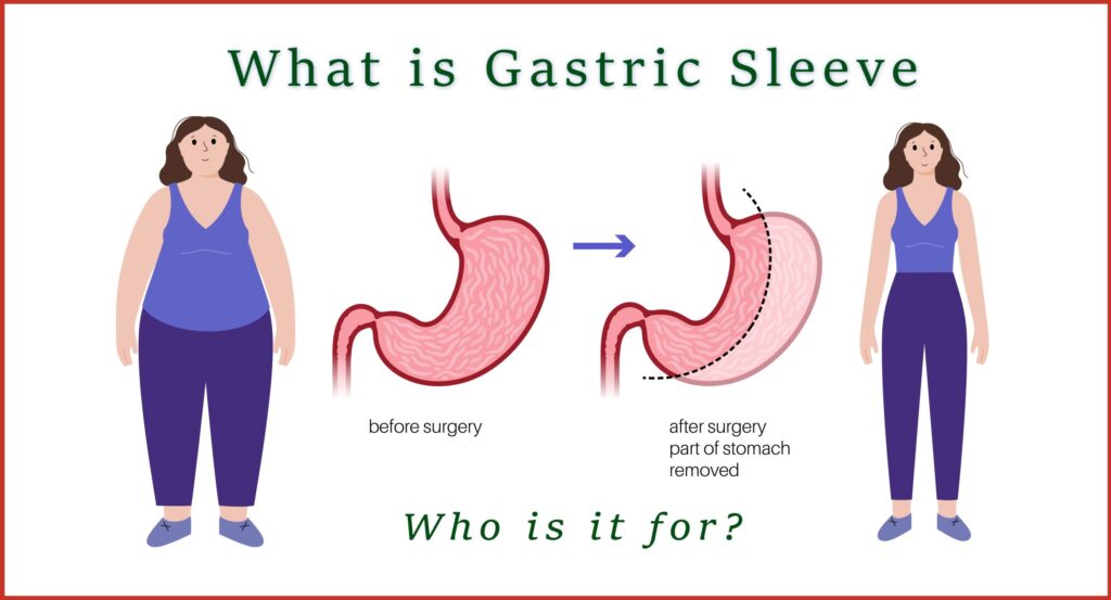 An overview of gastric sleeve surgery for weight loss and health improvement