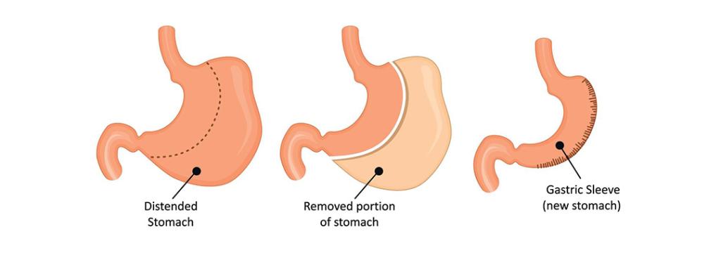 What is Gastric Sleeve Surgery - Illustration of Sleeve Gastrectomy Procedure
