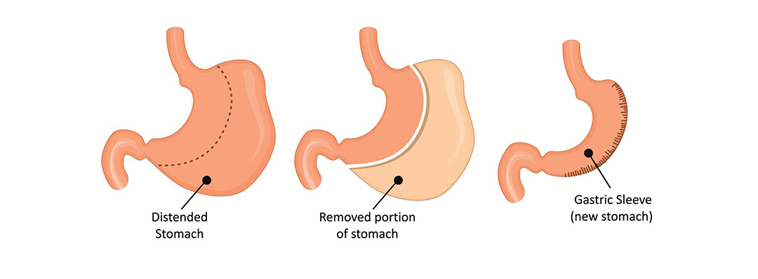 What is Gastric Sleeve Surgery - Illustration of Sleeve Gastrectomy Procedure