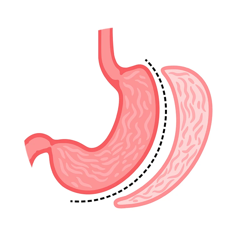 Gastric sleeve surgery showing reduced stomach size for weight loss