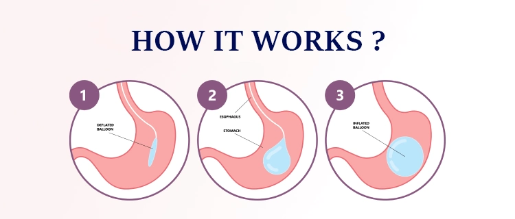 Illustration showing how the Allurion swallowable gastric balloon works in Turkey