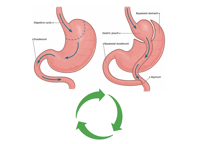 Gastric Bypass Revision