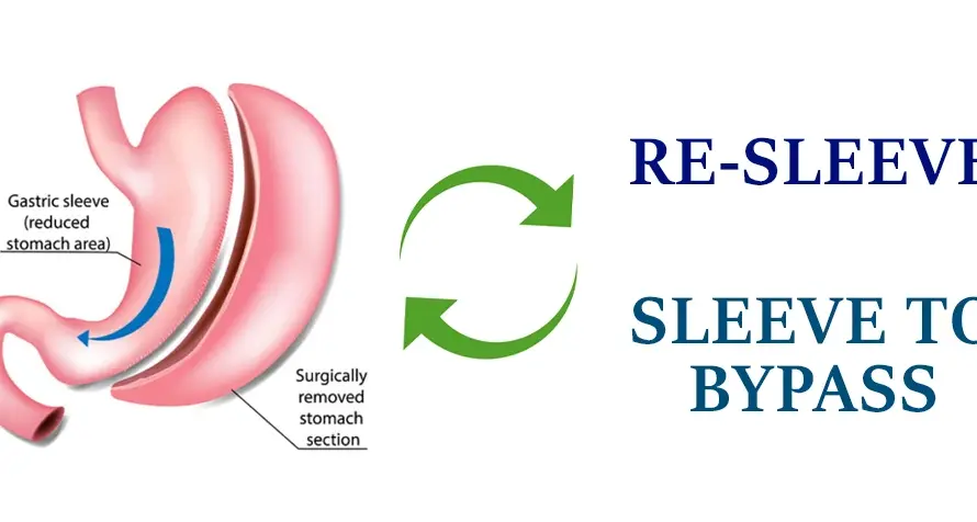 Illustration of gastric sleeve revision, a corrective bariatric surgery