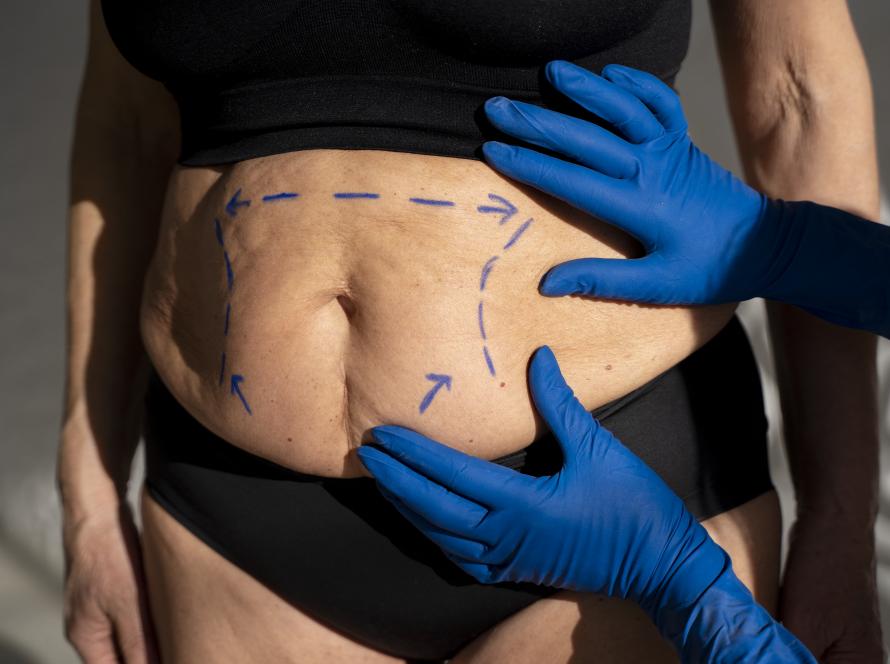Best Weight Loss Surgery