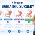 What Are the 4 Types of Bariatric Surgery?