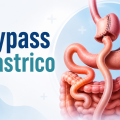 Bypass Gastrico Explained: Procedure, Cost, Benefits & Recovery