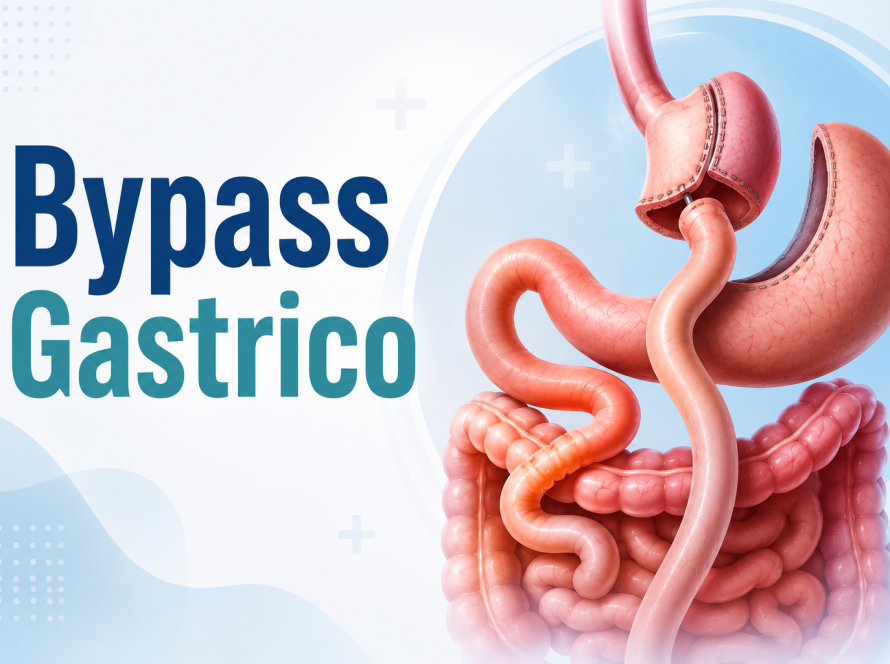 bypass gastriko