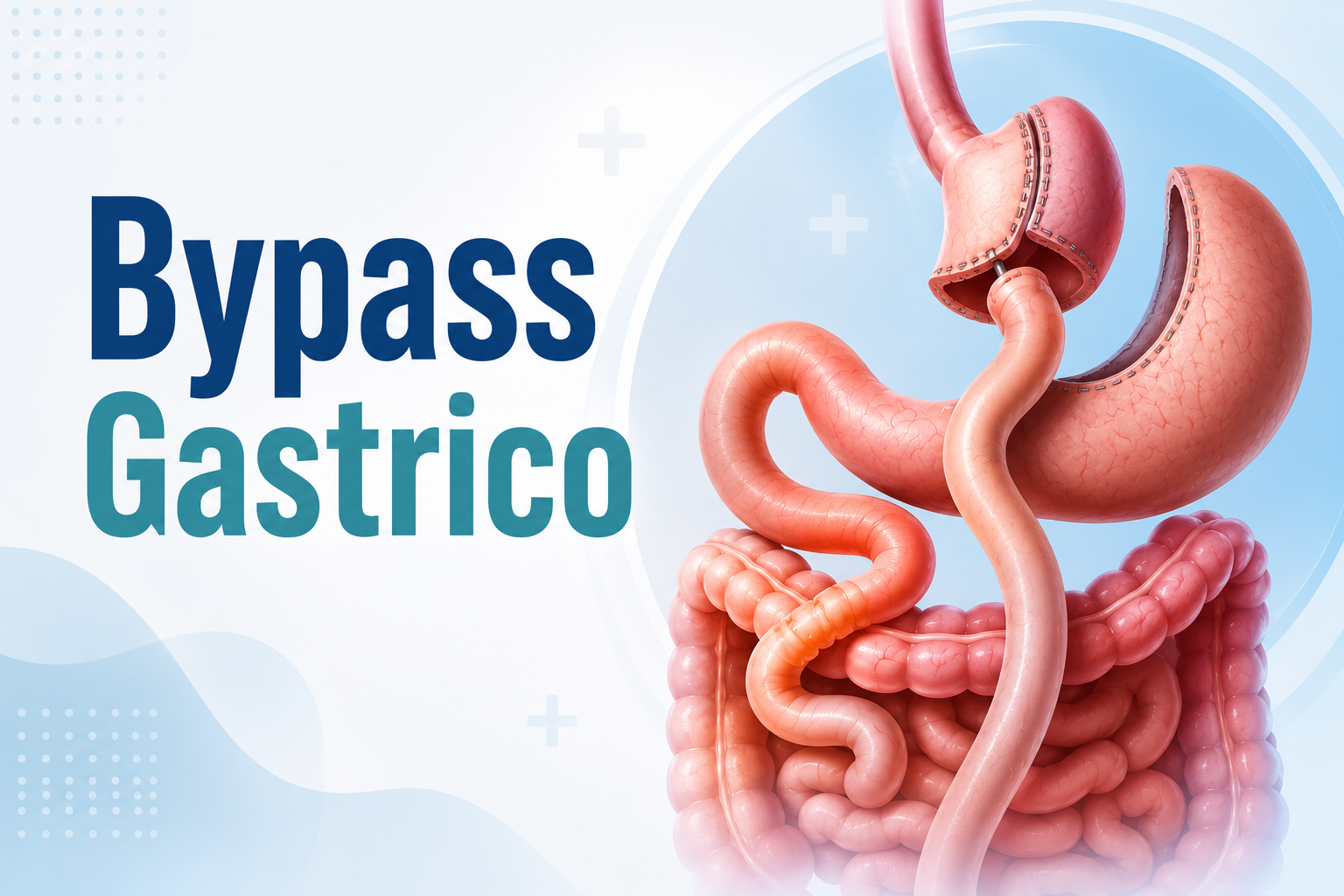 bypass gastrico