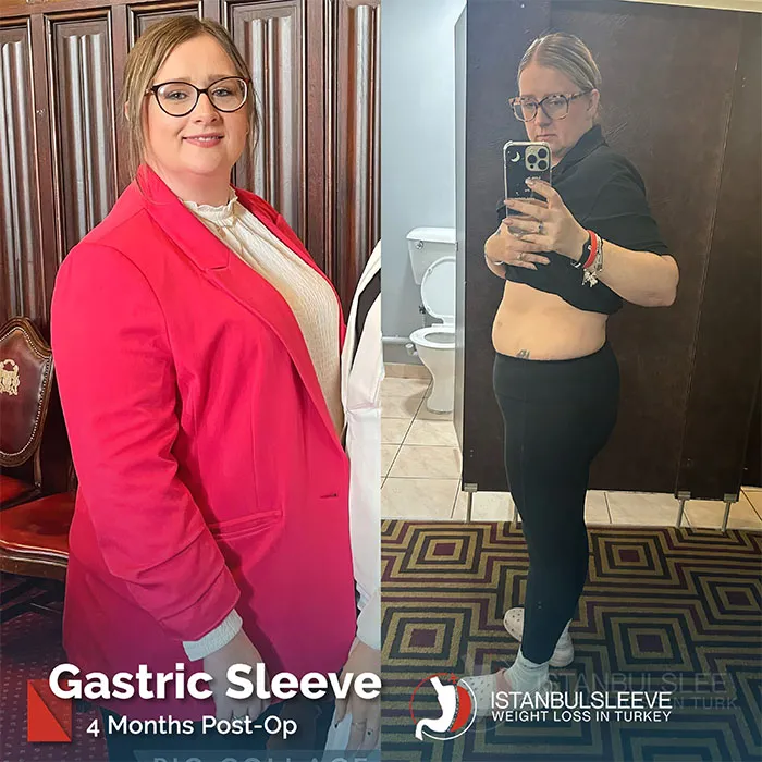 gastric-sleeve-before-after-2.jpg