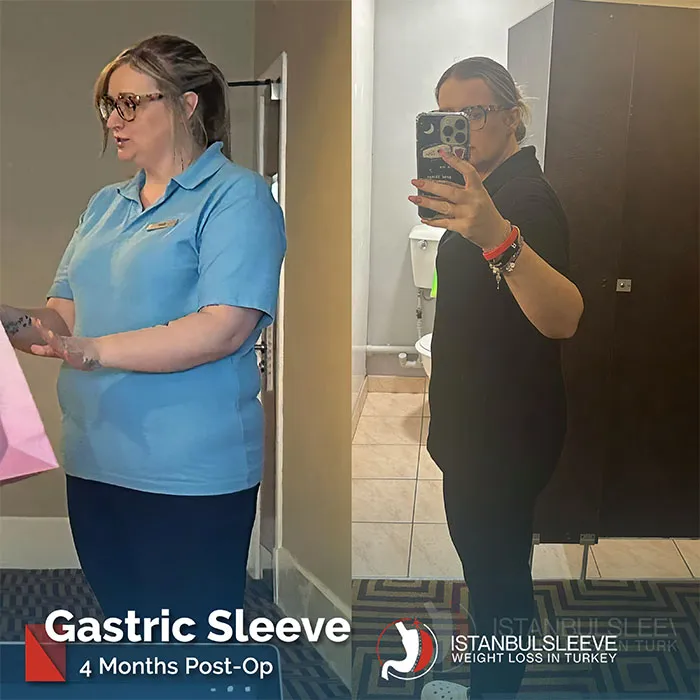 gastric-sleeve-before-after-3.jpg