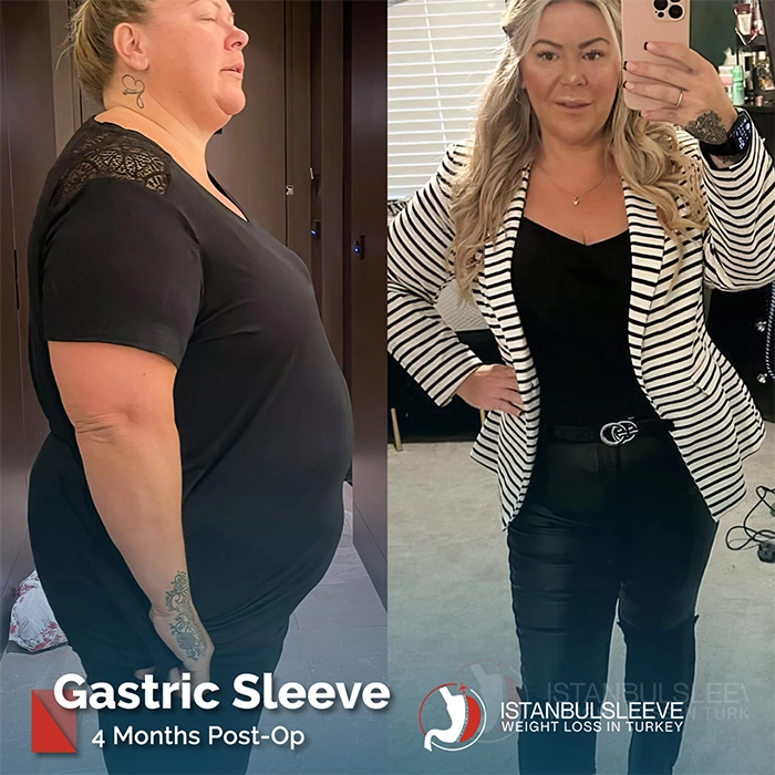 gastric-sleeve-before-after-4