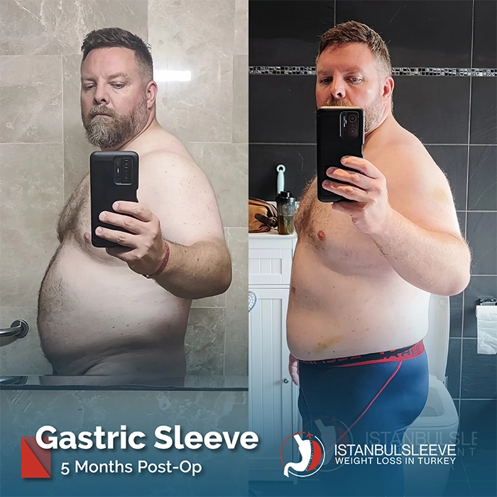 gastric-sleeve-before-after-6