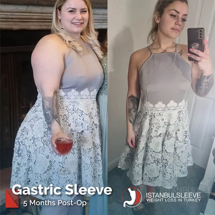 gastric-sleeve-before-after-7.jpg