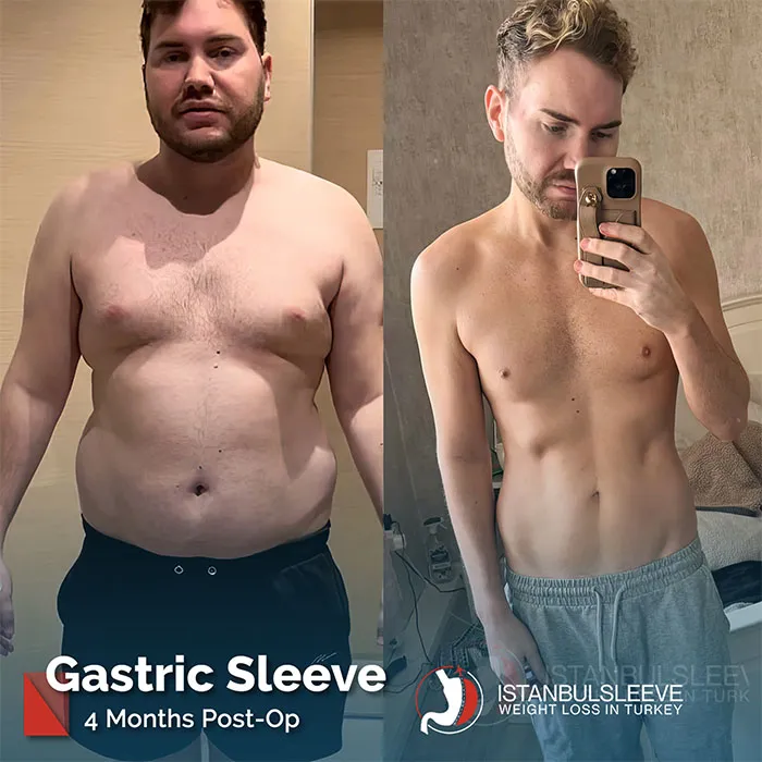 gastric-sleeve-before-after-8.jpg