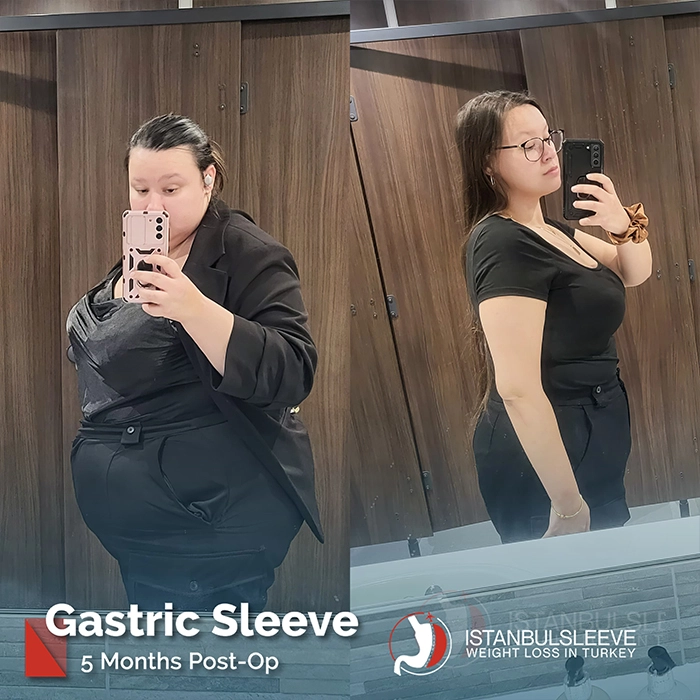 gastric-sleeve-before-after-9