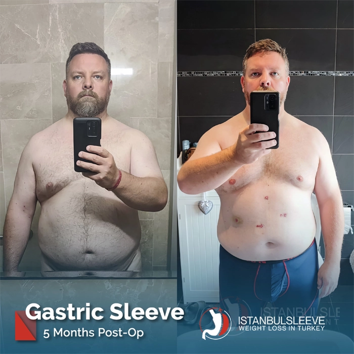 gastric-sleeve-before-after